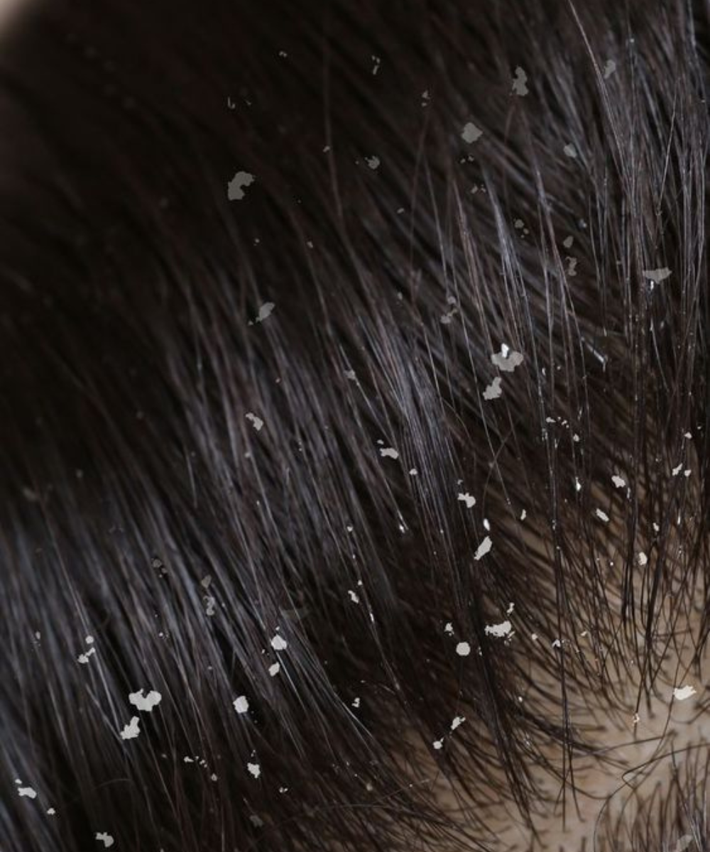 Шампоан против пърхот Kadiffe Anti-Dandruff + подарък
